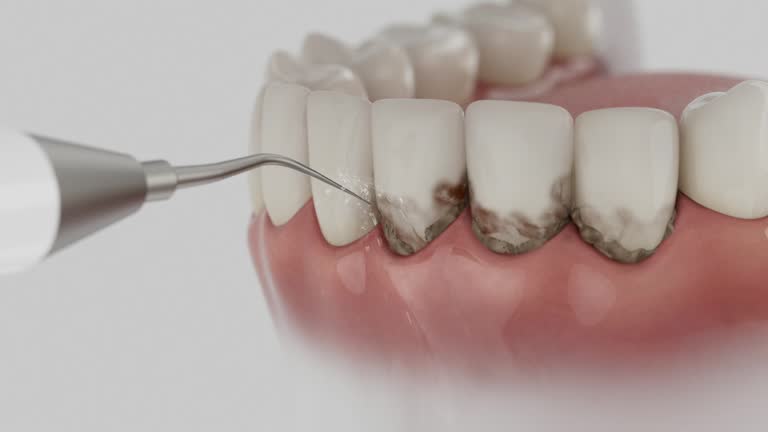 Trusted Wisdom Tooth Removal service in Albion, MI - Dentist Open Now